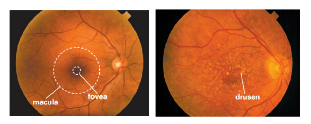 Amd Area Estimation from RGB Fundus Images Surpasses State of the Art Via U-Net Architectures and Loss Functions