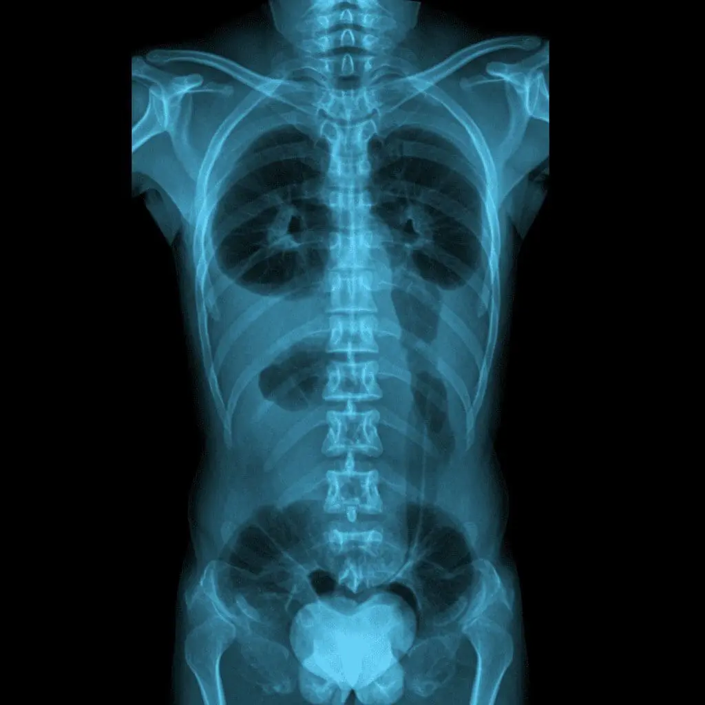 Patients Support AI as Radiologist Backup in Screening Mammography