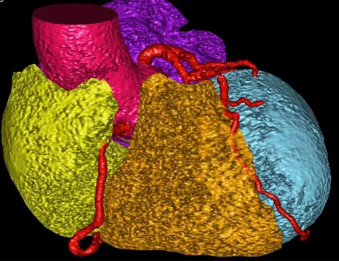 Case Western Reserve uses AI to predict heart risk