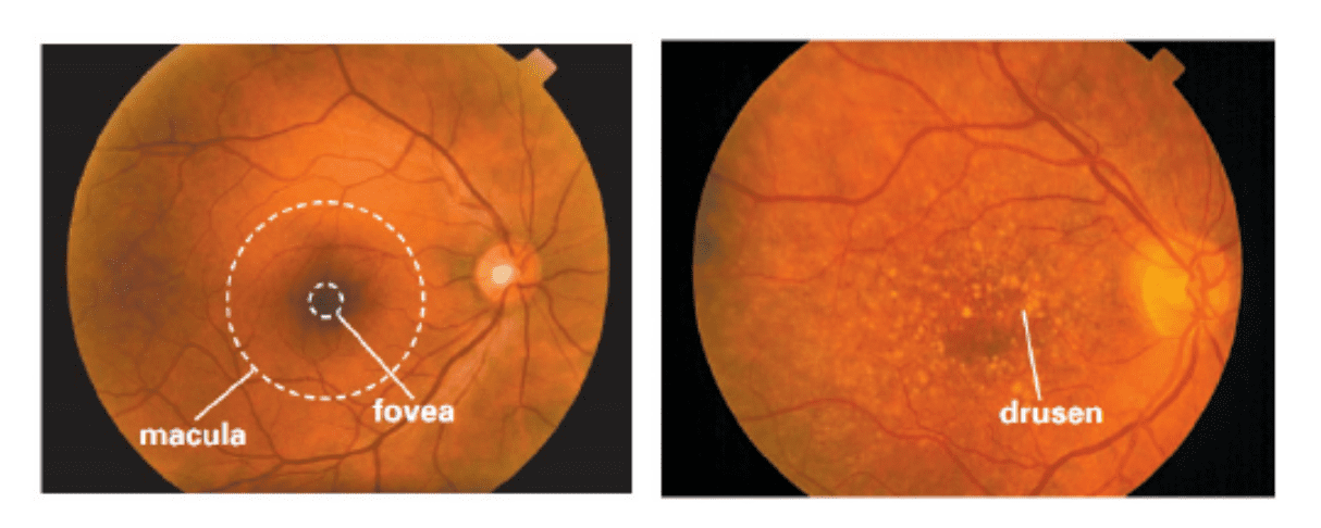 Amd Area Estimation from RGB Fundus Images Surpasses State of the Art Via U-Net Architectures and Loss Functions