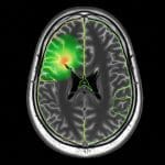 Glioma MRI Segmentation Achieves 0.929 Dice Score with Reduced Resources