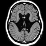 Penn State's 2026 Outlook: AI Speech Analysis for Early Alzheimer's Detection